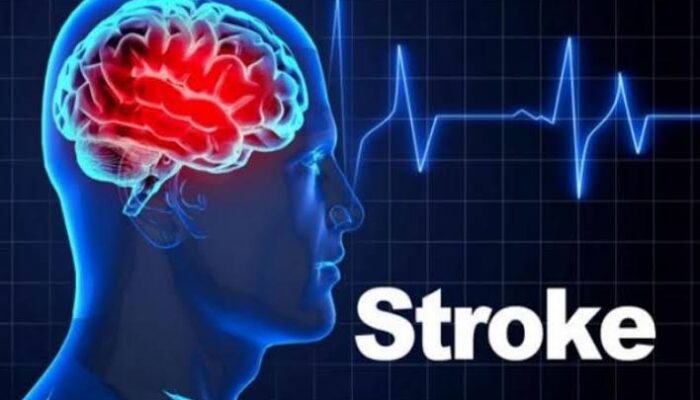 Gejala Awal Stroke yang Wajib Diketahui, Jangan Abaikan Tanda-Tandanya